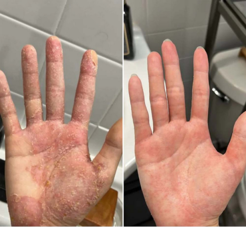 Krém na zánět pleti & zdravá pleť – Uklidňuje svědění, zarudnutí a šupinatění 50ml photo review